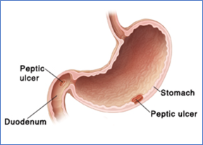 Peptic Ulcers123